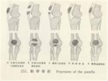 股四头肌肌腱断裂