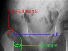 骨骺点状发育不良