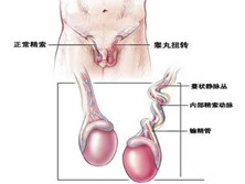 睾丸扭转