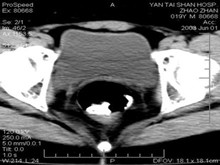 小儿46-XY单纯性腺发育不全综合征