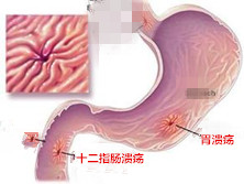 消化性溃疡