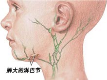 浅表淋巴结肿大