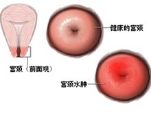 宫颈水肿