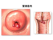 宫颈息肉