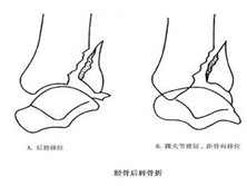 胫骨后唇骨折