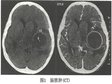 硬脑膜外和硬脑膜下脓肿