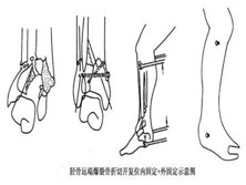 胫骨远端爆裂骨折