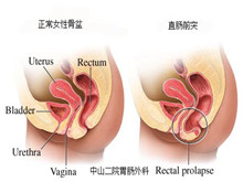 直肠前突