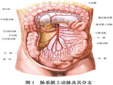 肠系膜上动脉栓塞