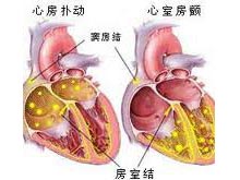 心房颤动