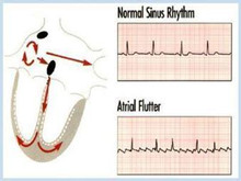 心房扑动