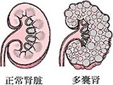 成人多囊肾