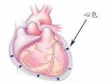 心包炎