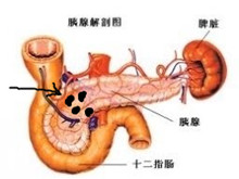 胰腺结石