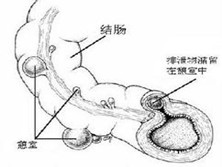 空肠、回肠憩室