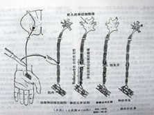 周围神经损伤