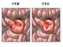 粘连性肠梗阻