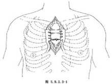 胸骨骨折