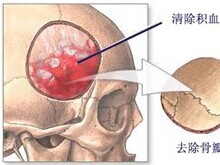 脑外伤后综合征