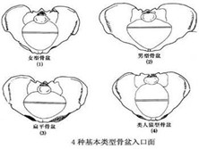 骨产道异常性难产