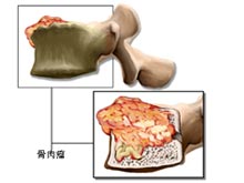 骨肉瘤