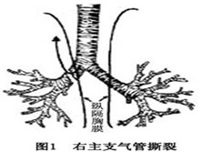 创伤性气管及主支气管损伤