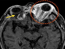眶骨髓炎