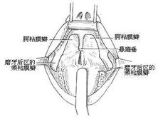 口咽部粘连