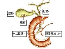 急性结石性胆囊炎