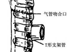 气管闭合性损伤