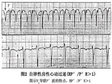 自律性房性心动过速