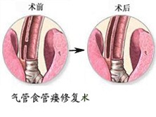 气管先天性疾病