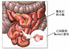 小儿梅克尔憩室