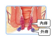 内痔