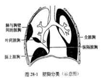 急性脓胸