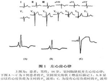 左心房心律
