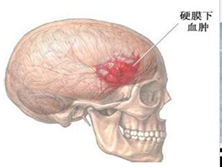 外伤性脑积水