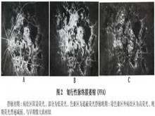 匐行性脉络膜萎缩