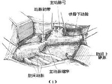 主动脉弓畸形