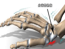 腕舟状骨骨折