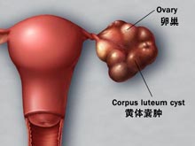 黄体囊肿