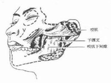 颏下间隙感染