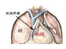 原发性纵膈肿瘤