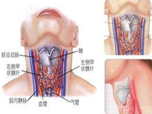 亚临床甲状腺功能减退症