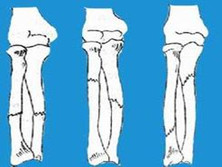 尺桡骨干双骨折
