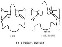 寰椎骨折