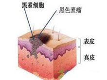 黑色素瘤