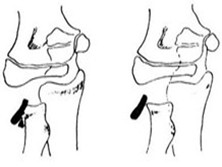 桡骨颈骨折和桡骨头骨骺分离