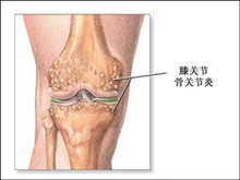 退行性骨关节炎