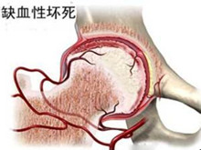 股骨头缺血性坏死